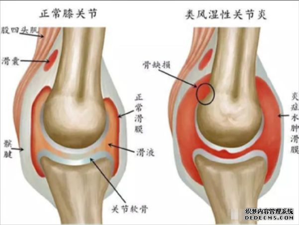 <b>类风湿性关节炎：不容忽视的健康威胁</b>