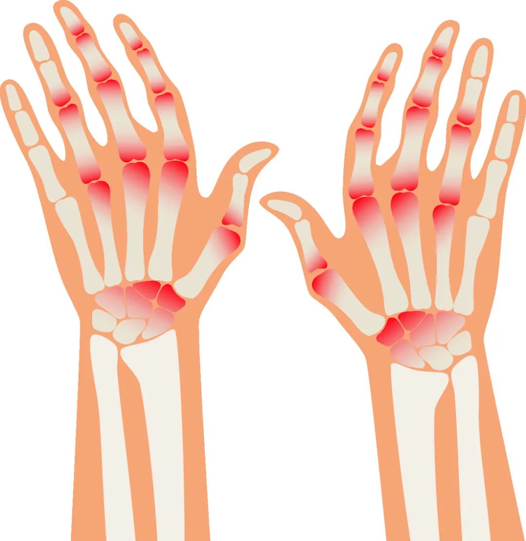 探寻玉溪痛风医院：先了解痛风那些事