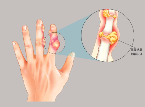 认识痛风：一种 “结晶” 引发的关节炎症