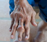 痛风性关节炎骨侵蚀的中医证型特点及防治