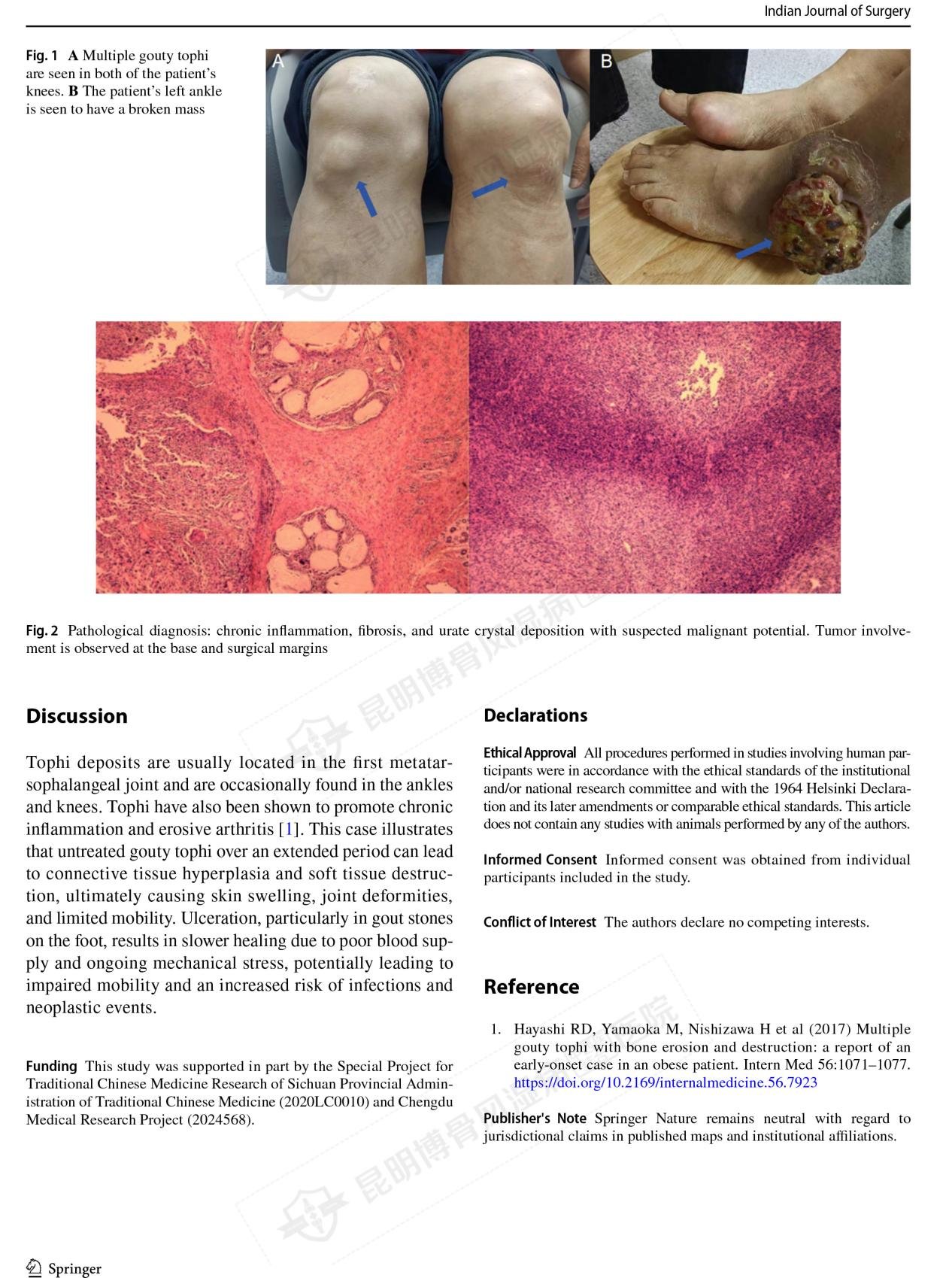我院研究改写痛风石认知，恶性转化有新发现