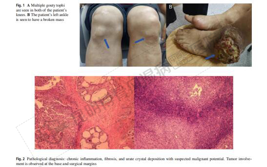 痛风石内部存在显著纤维化、慢性炎症及尿酸盐晶体沉积，且肿瘤累及基底和切缘
