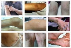 医生详解：必须知道的风湿各阶段症状