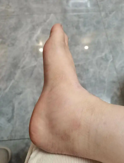夏季痛风高发,痛风患者需要注意哪些